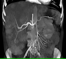 Metastatic Carcinoid Tumor - CTisus CT Scan