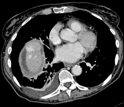 Flow Related Av Shunting in Liver - CTisus CT Scan