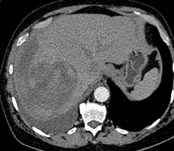 Hepatoma With Spontaneous Bleed in the Liver - CTisus CT Scan