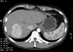 Focal Nodular Hyperplasia (FNH) - CTisus CT Scan