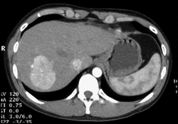 Focal Nodular Hyperplasia (FNH) - CTisus CT Scan