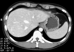 Focal Nodular Hyperplasia (FNH) - CTisus CT Scan