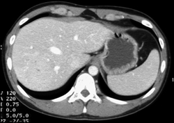 Focal Nodular Hyperplasia (FNH) - CTisus CT Scan