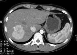 Focal Nodular Hyperplasia (FNH) - CTisus CT Scan