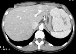 Focal Nodular Hyperplasia (FNH) - CTisus CT Scan