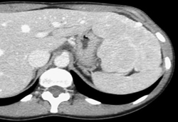 Focal Nodular Hyperplasia (FNH) - CTisus CT Scan