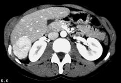 Focal Nodular Hyperplasia (FNH) - CTisus CT Scan