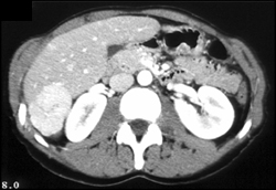 Focal Nodular Hyperplasia (FNH) - CTisus CT Scan