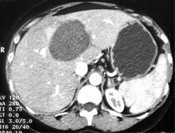 Hepatic Adenoma-unusual Appearance - CTisus CT Scan