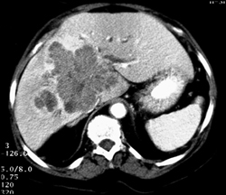 Hepatic Pseudotumor - CTisus CT Scan