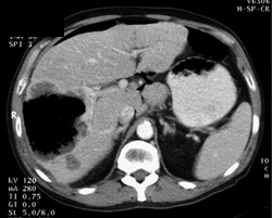 Liver Necrosis Sp Chemotherapy - CTisus CT Scan