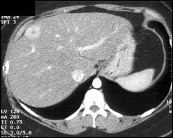 Focal Nodular Hyperplasia (FNH) - CTisus CT Scan