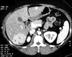 Focal Nodular Hyperplasia (FNH) - CTisus CT Scan