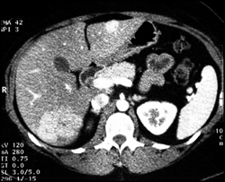 Focal Nodular Hyperplasia (FNH) - CTisus CT Scan