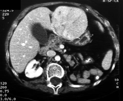 Hepatic Adenoma - CTisus CT Scan