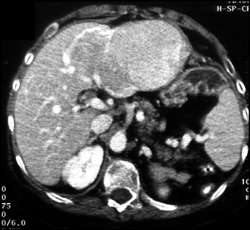 Hepatic Adenoma - CTisus CT Scan