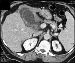 Acute Cholecystitis - CTisus CT Scan