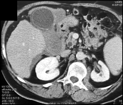 Acute Cholecystitis - CTisus CT Scan