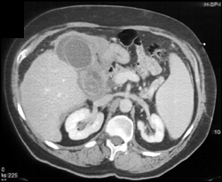 Acute Cholecystitis - CTisus CT Scan