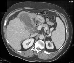 Acute Cholecystitis - CTisus CT Scan