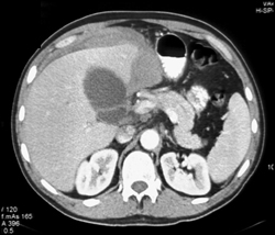 Perihepatic Bleed S/P Bx - CTisus CT Scan