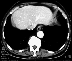 Hepatoma Invades the Inferior Vena Cava (IVC) - CTisus CT Scan