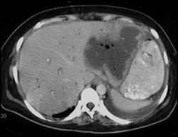 Liver Infarct and Abscess - CTisus CT Scan