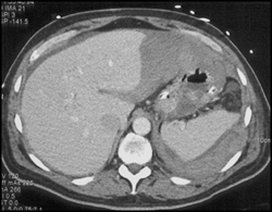 Perihepatic and Perisplenic Blood - CTisus CT Scan