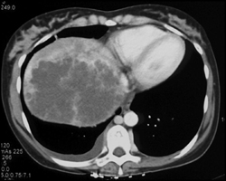 Hepatoma - CTisus CT Scan