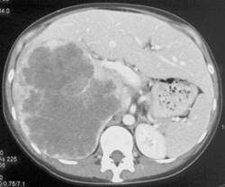 Hepatoma - CTisus CT Scan