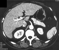 Cirrhosis - CTisus CT Scan