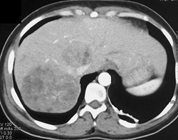 Hepatoma With Bone Metastases - CTisus CT Scan