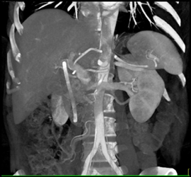 Hepatic Artery Arises Directly Off of Aorta - CTisus CT Scan