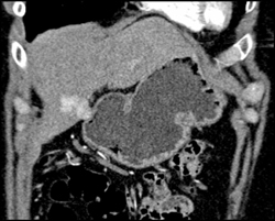 Focal Nodular Hyperplasia (FNH) - CTisus CT Scan