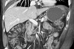 Focal Nodular Hyperplasia (FNH) - CTisus CT Scan