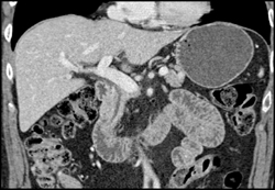 Focal Nodular Hyperplasia (FNH) - CTisus CT Scan