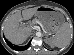 Hepatic Artery Arises Off of Aorta - CTisus CT Scan