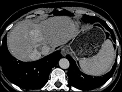 Hepatoma - CTisus CT Scan