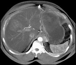 Hemangioma - CTisus CT Scan