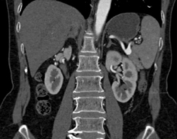 Splenic Artery Aneurysm in Hepatitis B Patient - CTisus CT Scan