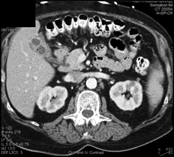 Gallstones and Chronic Cholecystitis - CTisus CT Scan