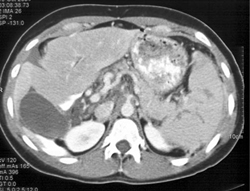 Liver and Splenic Lacerations - CTisus CT Scan