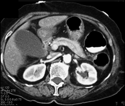 Acute Cholecystitis - CTisus CT Scan