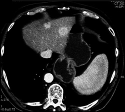 Islet Cell Tumor of Pancreatic Tail With Liver Metastases - CTisus CT Scan