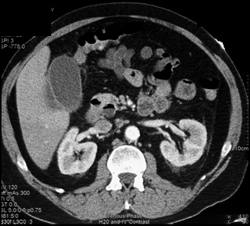 Acute Cholecystitis - CTisus CT Scan