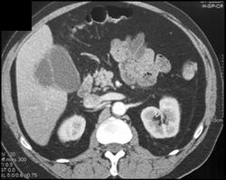 Acute Cholecystitis - CTisus CT Scan