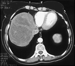 Hepatoma - CTisus CT Scan