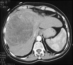 Hepatoma - CTisus CT Scan