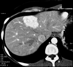 Focal Nodular Hyperplasia (FNH) - CTisus CT Scan