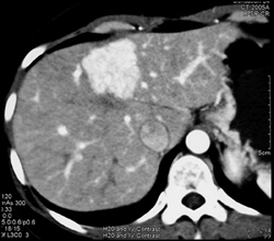 Focal Nodular Hyperplasia (FNH) - CTisus CT Scan